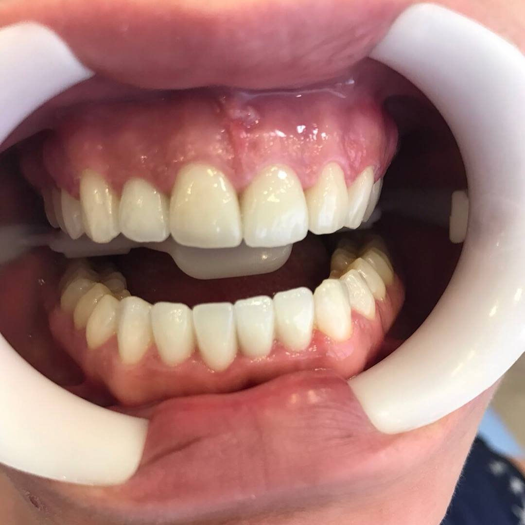 Dhëmbë të bardhë pas trajtimit estetik në klinikën dentare GOJA Smiles