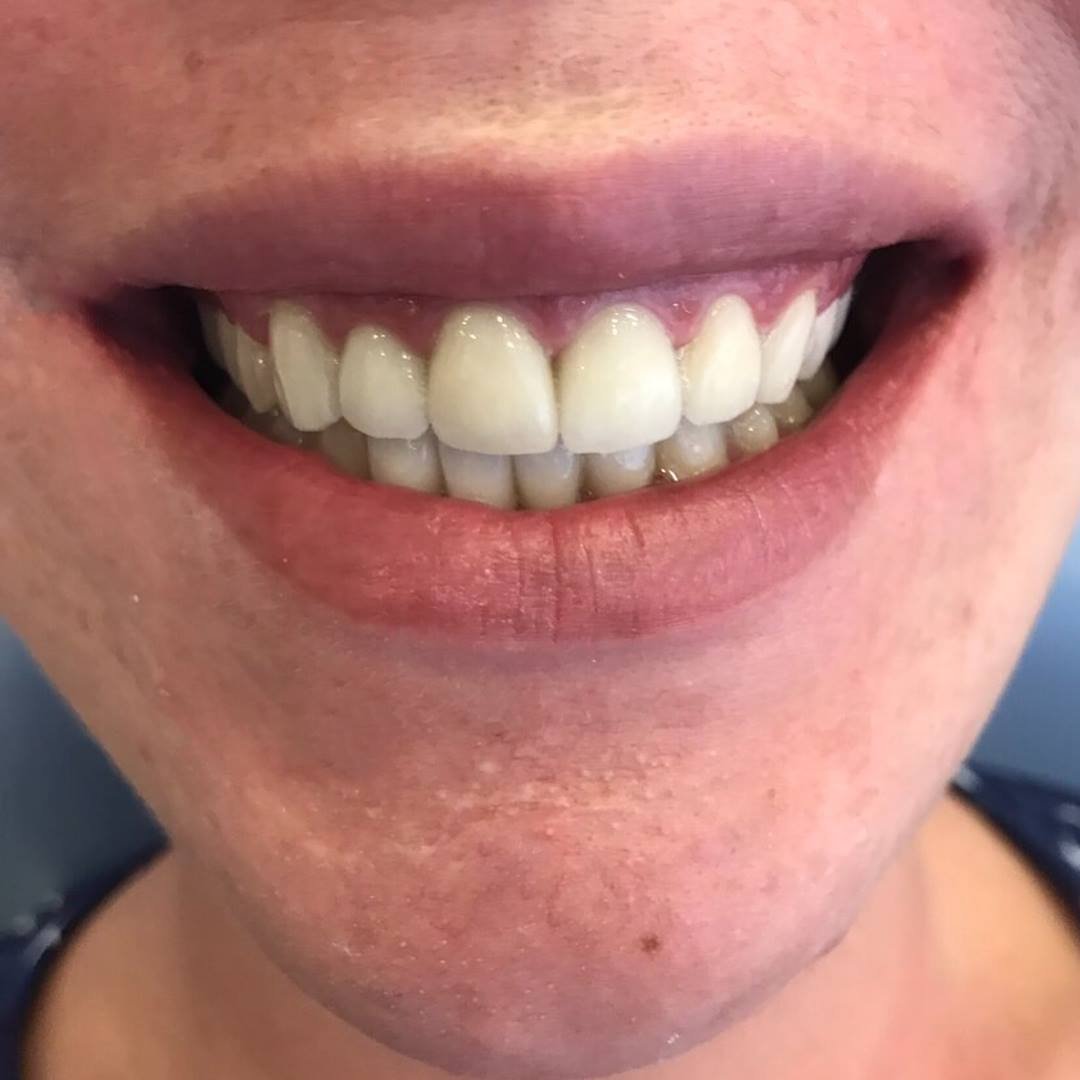 Buzëqeshje e shëndetshme pas trajtimit dentar në GOJA Smiles, Prishtinë