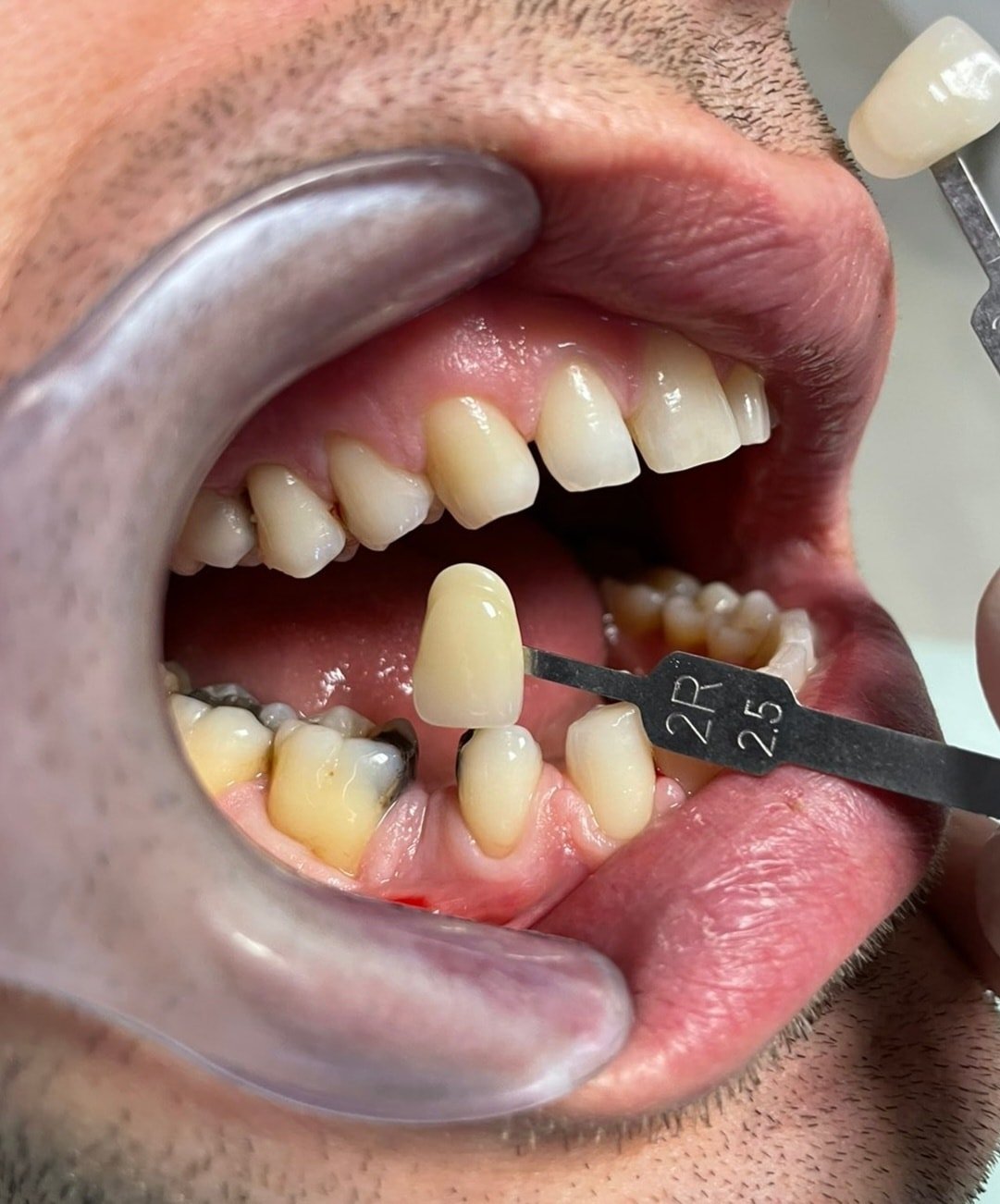Përzgjedhja e ngjyrës së dhëmbëve me udhëzues nuancash në klinikën dentare GOJA Smiles