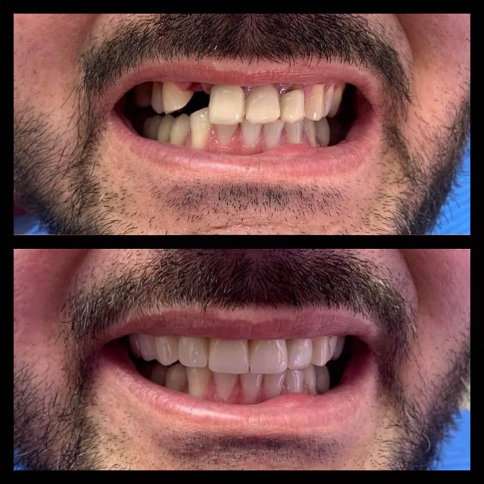 Para dhe pas: zëvendësimi i dhëmbit të munguar me kurorë dentare në GOJA Smiles
