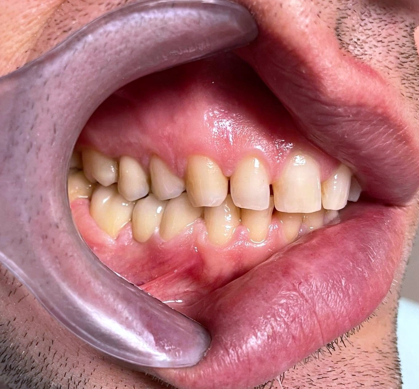 Pamje anësore e dhëmbëve para trajtimit në klinikën GOJA Smiles