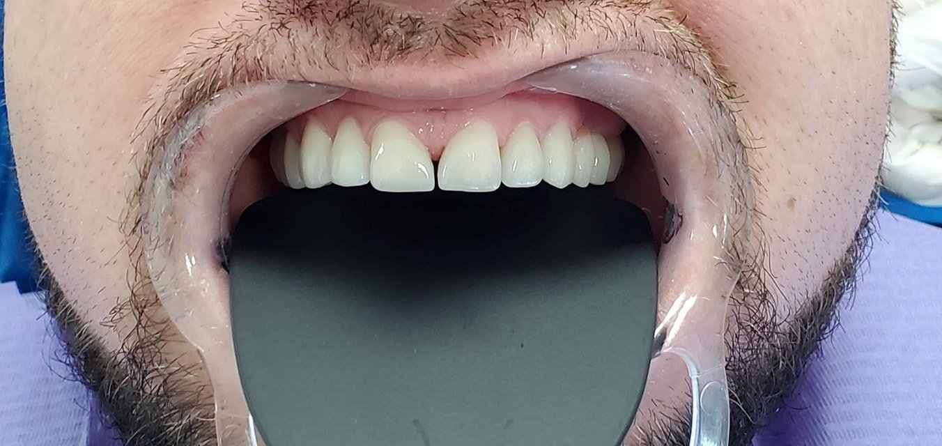 Veneera porcelani në dhëmbët e sipërm — rezultat në klinikën GOJA Smiles