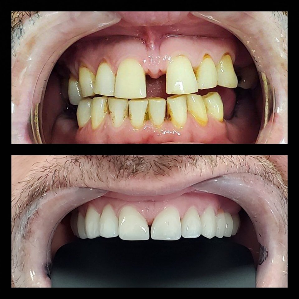 Modele kurorash dentare të punuara me precizion për pacientët e GOJA Smiles