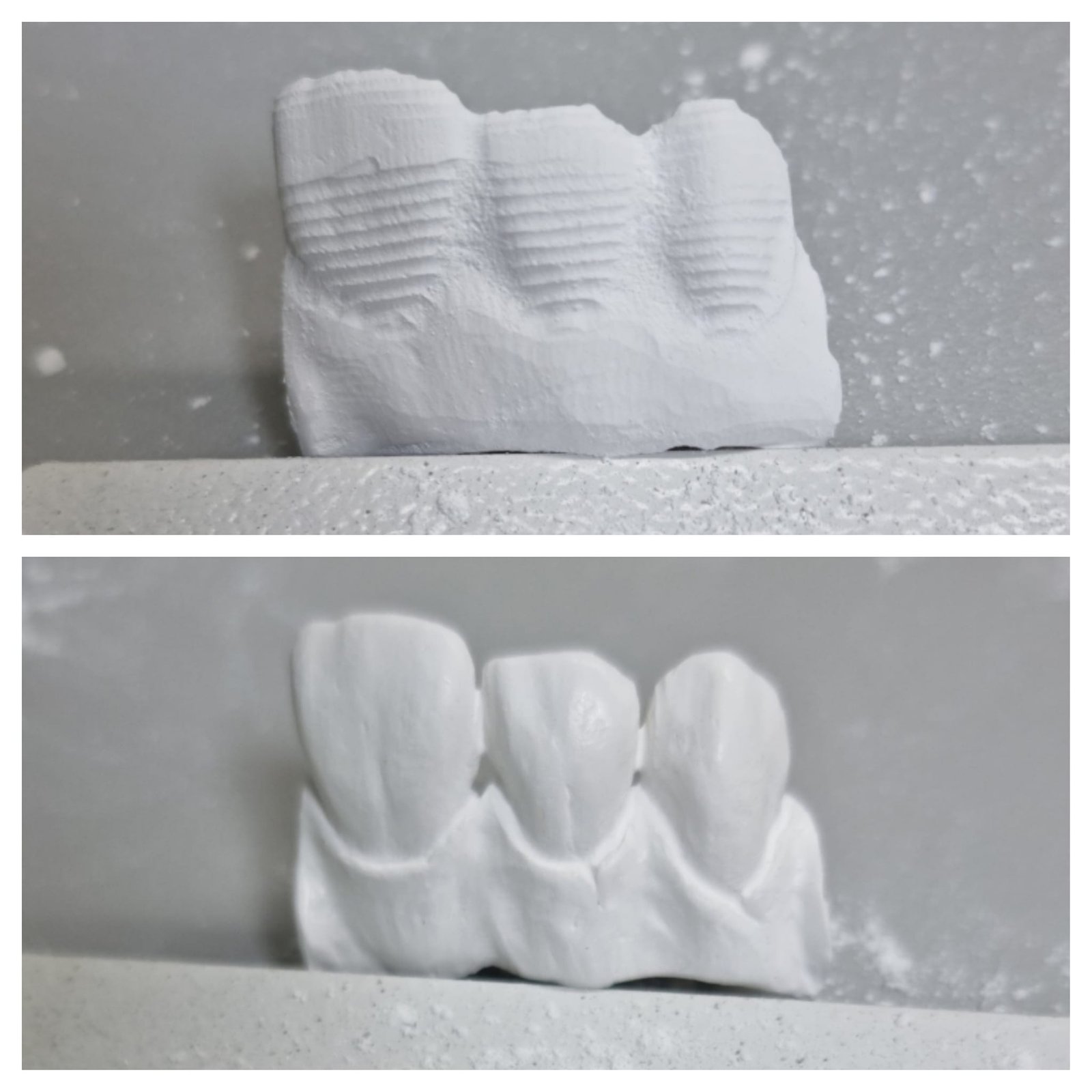 Rezultat trajtimi dentar në klinikën dentare GOJA Smiles në Prishtinë