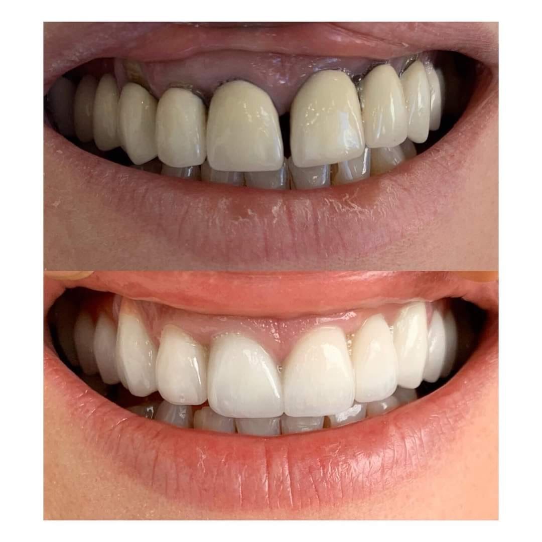 Para dhe pas: veneera dentare për një buzëqeshje të re — GOJA Smiles