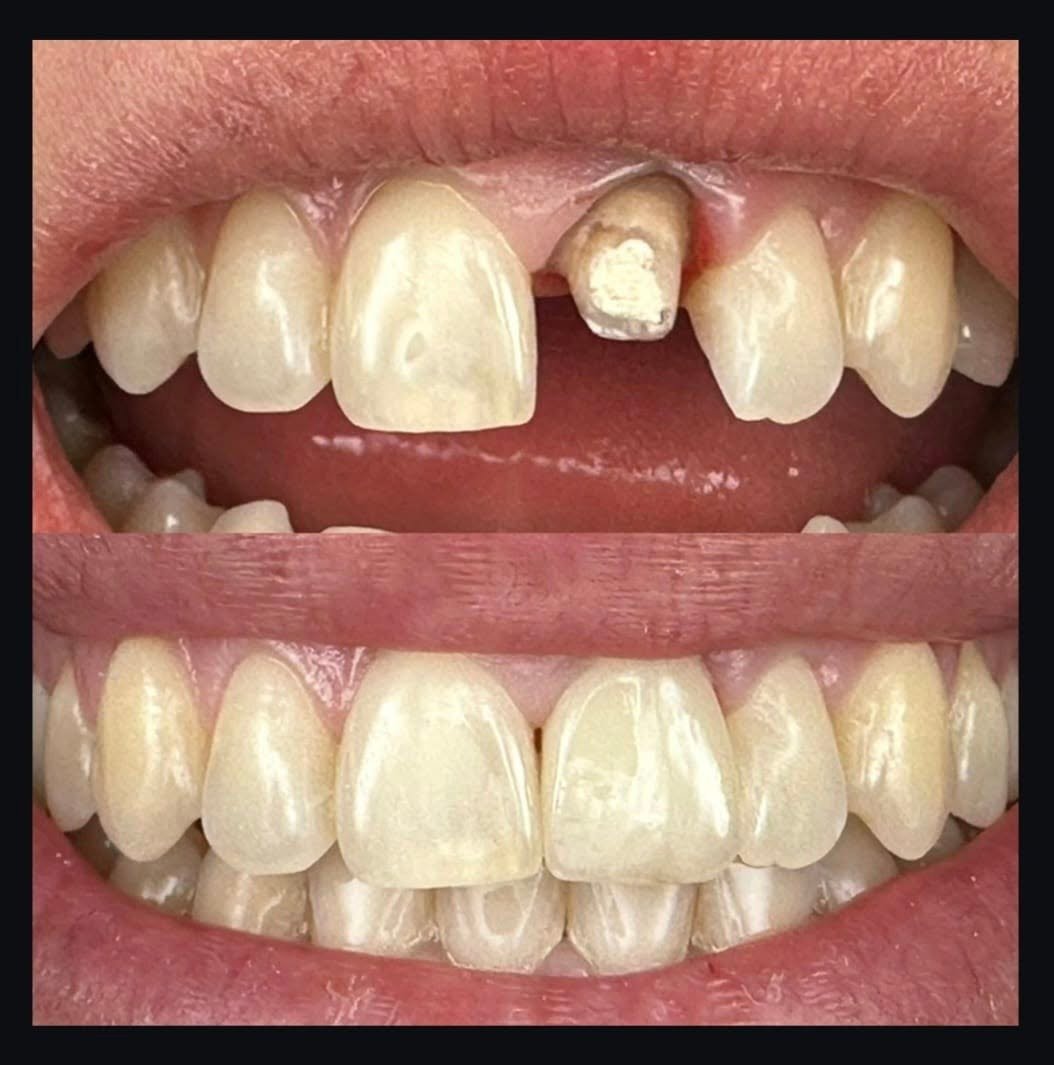 Para dhe pas: restaurimi i dhëmbit të dëmtuar me kurorë dentare në GOJA Smiles