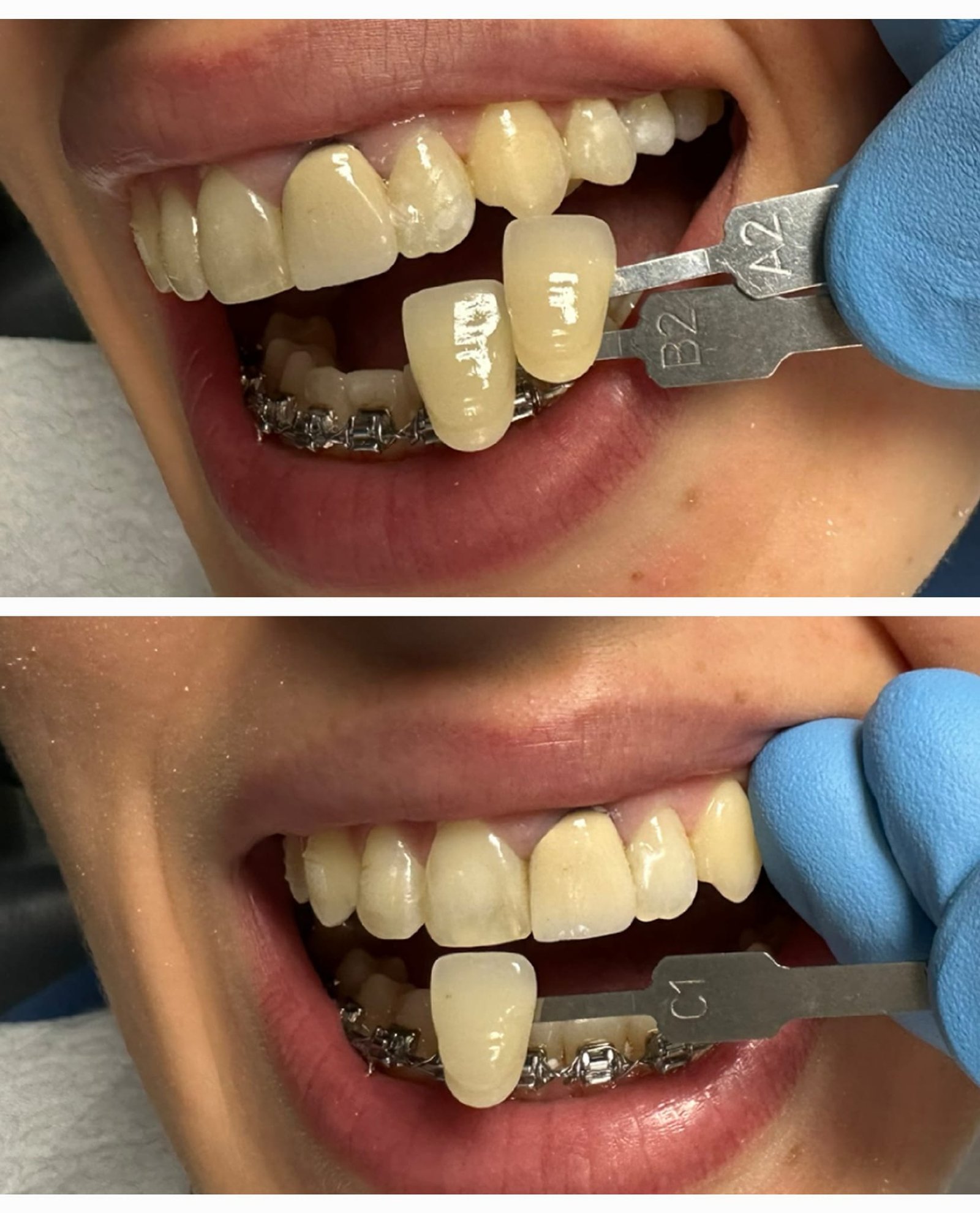 Matja e ngjyrës së dhëmbëve gjatë trajtimit ortodontik në klinikën GOJA Smiles
