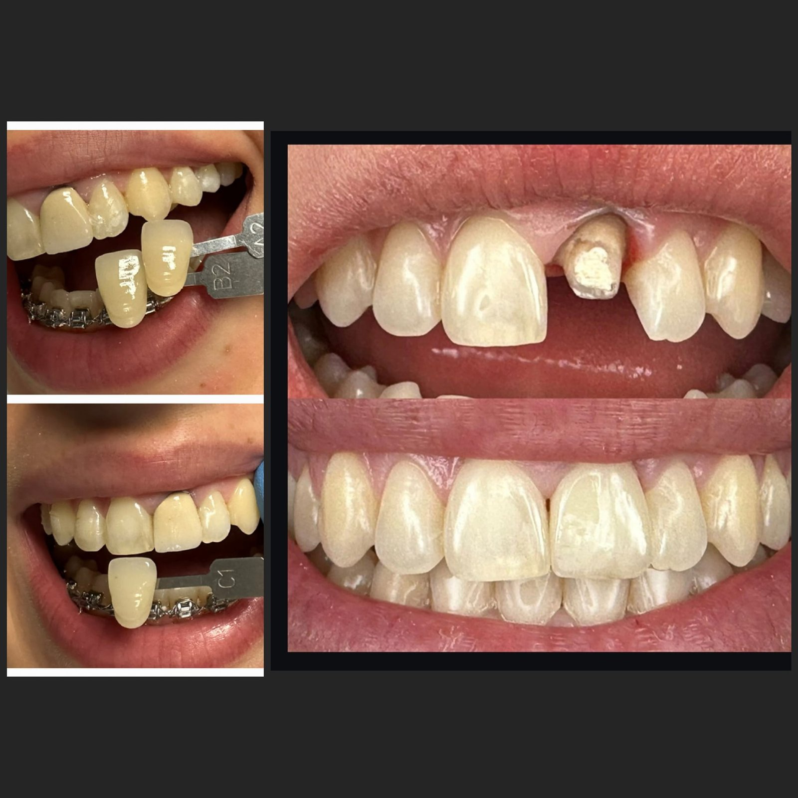 Para dhe pas: kurorë dentare mbi dhëmb të dëmtuar — klinika GOJA Smiles