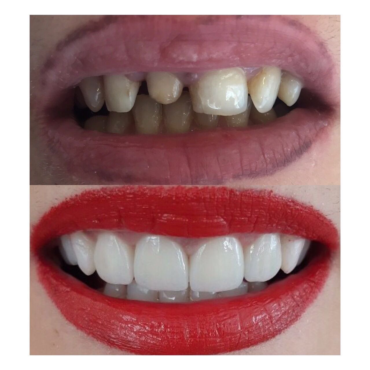 Para dhe pas: transformimi i buzëqeshjes me veneera në klinikën GOJA Smiles