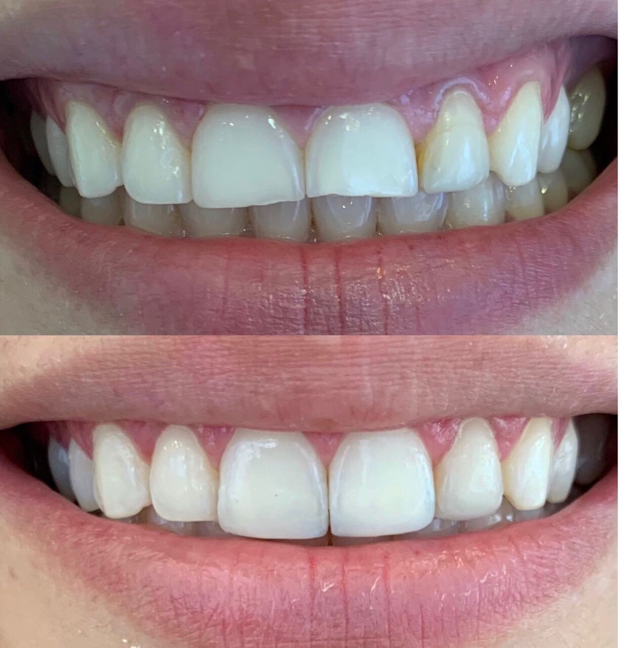 Para dhe pas: zbardhimi profesional i dhëmbëve në GOJA Smiles