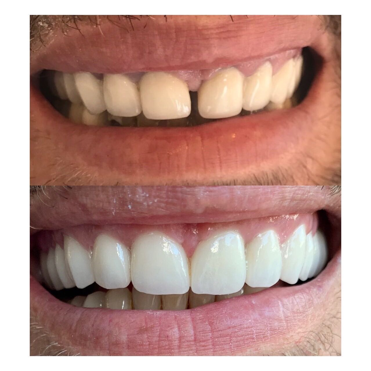 Para dhe pas: mbyllja e hapësirës mes dhëmbëve me veneera — GOJA Smiles