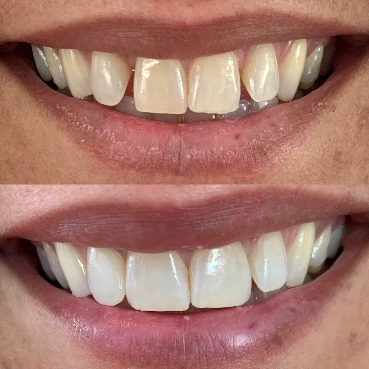 Para dhe pas zbardhimit të dhëmbëve — klinika dentare GOJA Smiles